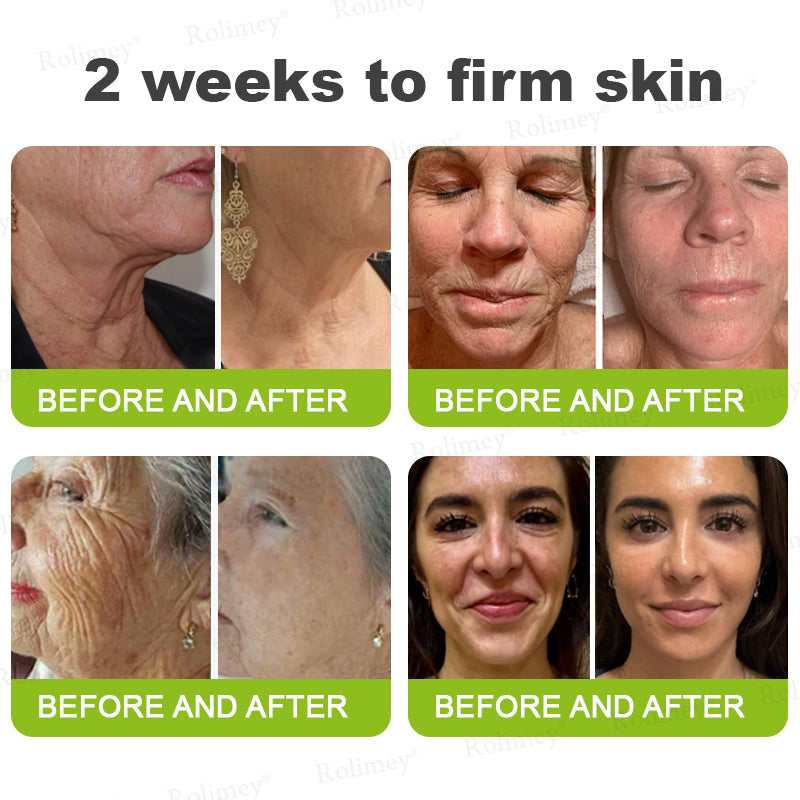 🌟👨‍⚕️Made and shipped from the UK 💫Rolimey® Botox & Vita-A Retinol Shot Wrinkle-Lift Tightening cream - Last Day Promotion 70% OFF