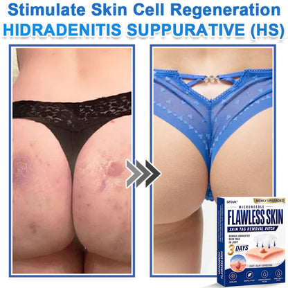 ⚡GFOUK® 2026 Newly Upgraded 2-in-1 Microneedle Hydrocolloid Patches | Removes Raised Moles, Acne, Flat Warts, and Skin Tags | Improves Wrinkles, Scars, and Blemishes | Invisible Acne Patches for Face & Body