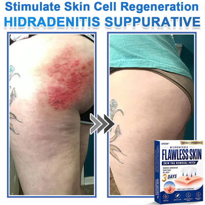 ⚡GFOUK® 2026 Newly Upgraded 2-in-1 Microneedle Hydrocolloid Patches | Removes Raised Moles, Acne, Flat Warts, and Skin Tags | Improves Wrinkles, Scars, and Blemishes | Invisible Acne Patches for Face & Body