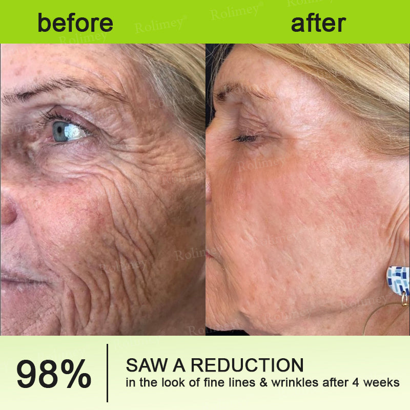 🌟👨‍⚕️Made and shipped from the UK 💫Rolimey® Botox & Vita-A Retinol Shot Wrinkle-Lift Tightening cream - Last Day Promotion 70% OFF