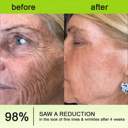 🌟👨‍⚕️Made and shipped from the UK 💫Rolimey® Botox & Vita-A Retinol Shot Wrinkle-Lift Tightening cream - Last Day Promotion 70% OFF
