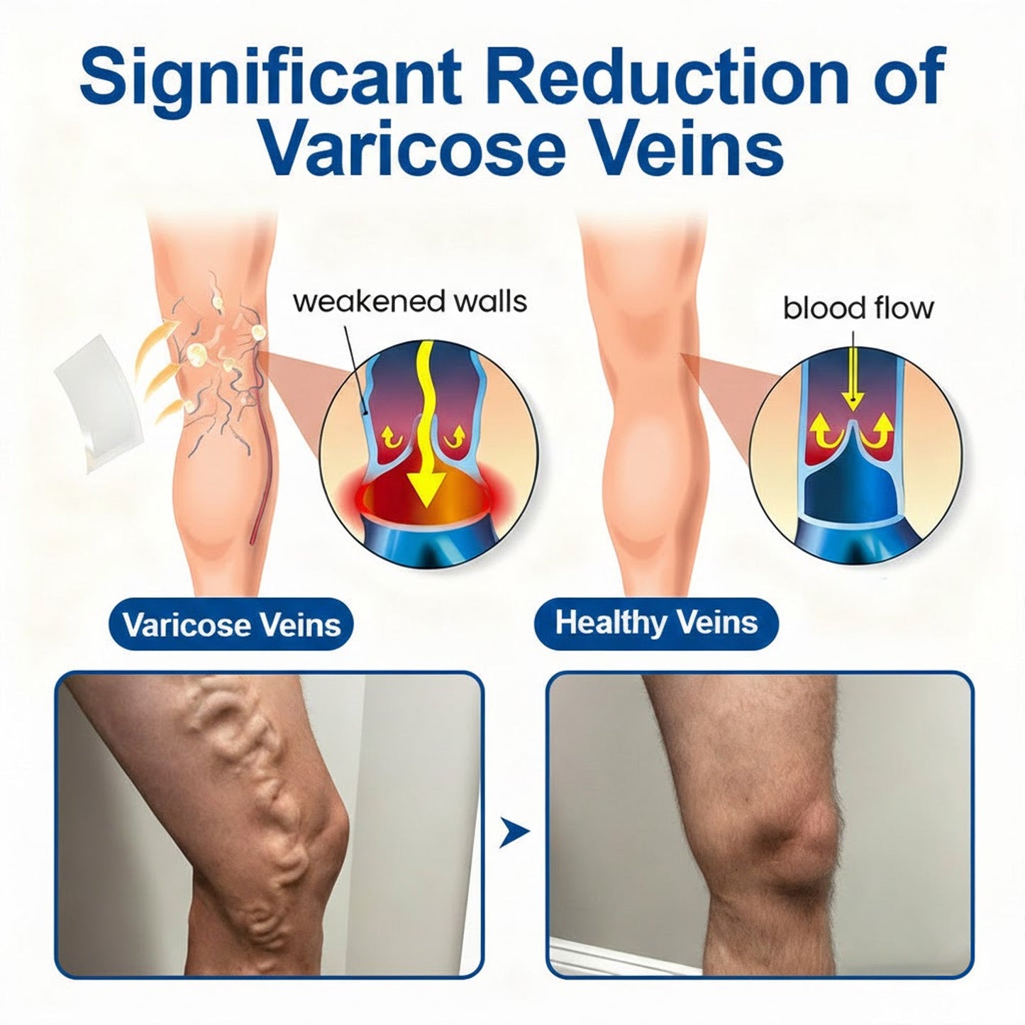 🇬🇧👨‍⚕️🔥GFOUK® VeinEase Microneedle Care Patch⚡Instant Relief, Long-Term Results