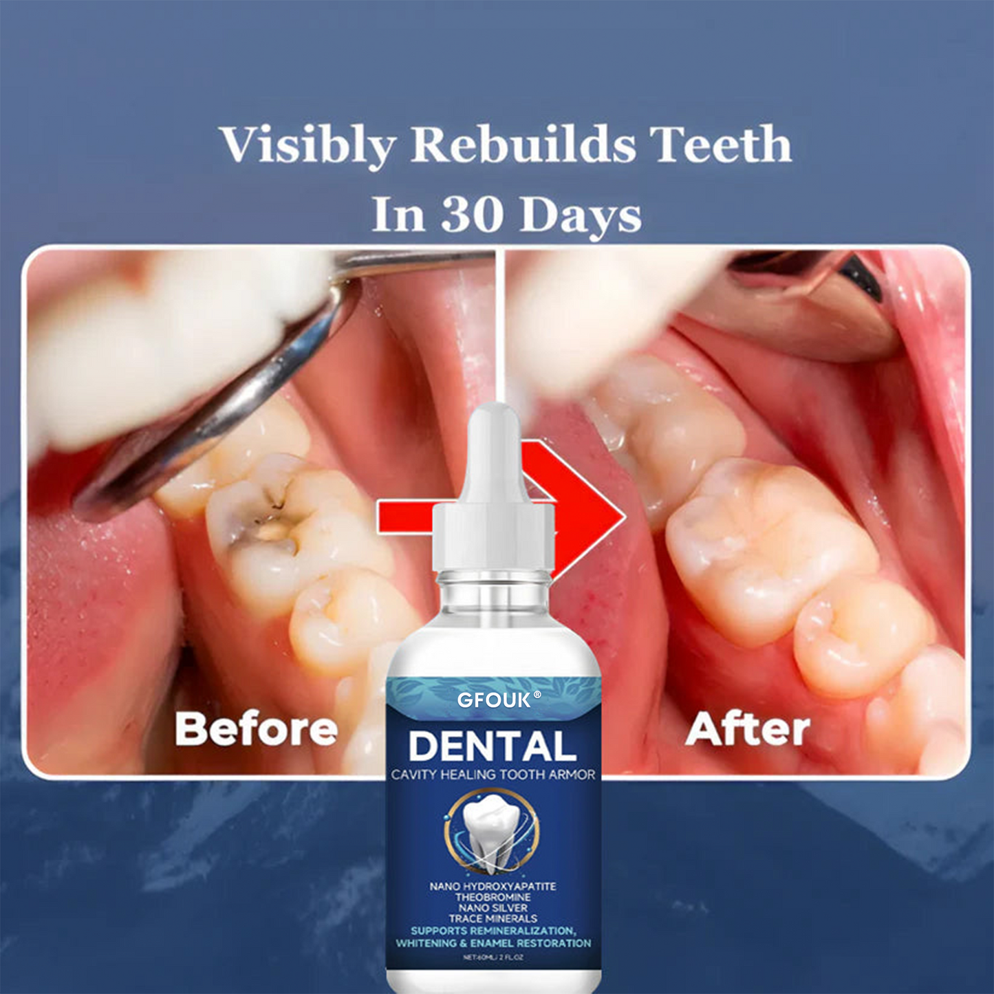 💎💎GFOUK™ Tooth Armor: Nano-Hydroxyapatite Drops for Cavity Defense