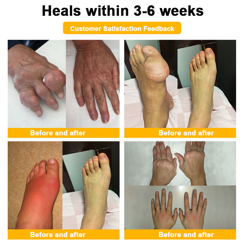 👨‍⚕️Official Shop:Rolimey® Bee Venom Pain Relief Bone Healing Cream 👨‍⚕️(Reduction of joint swelling, pain, stiffness, redness, heat, muscle soreness and joint fatigue)