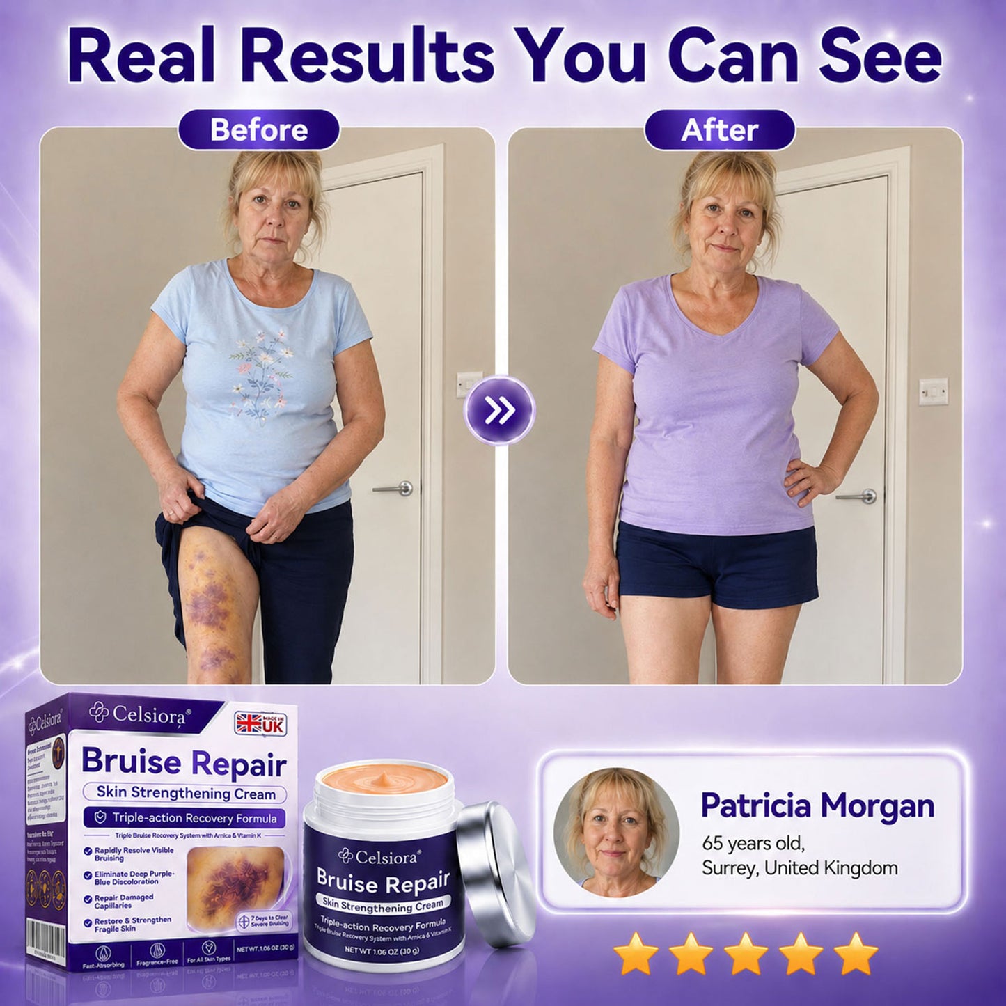 👨‍⚕️Over 100,000 units sold💕 - Rolimey® cream to repair bruises and strengthen the skin