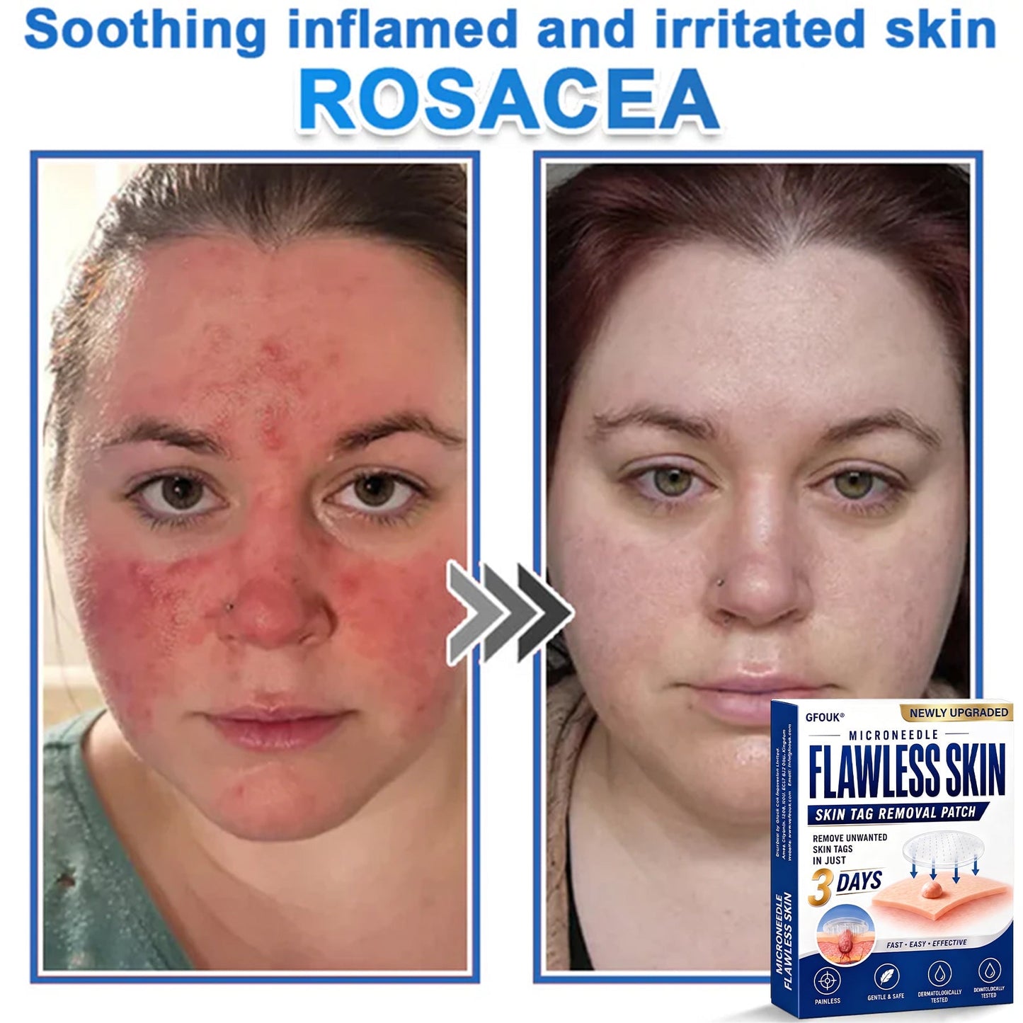⚡GFOUK® 2026 Newly Upgraded 2-in-1 Microneedle Hydrocolloid Patches | Removes Raised Moles, Acne, Flat Warts, and Skin Tags | Improves Wrinkles, Scars, and Blemishes | Invisible Acne Patches for Face & Body