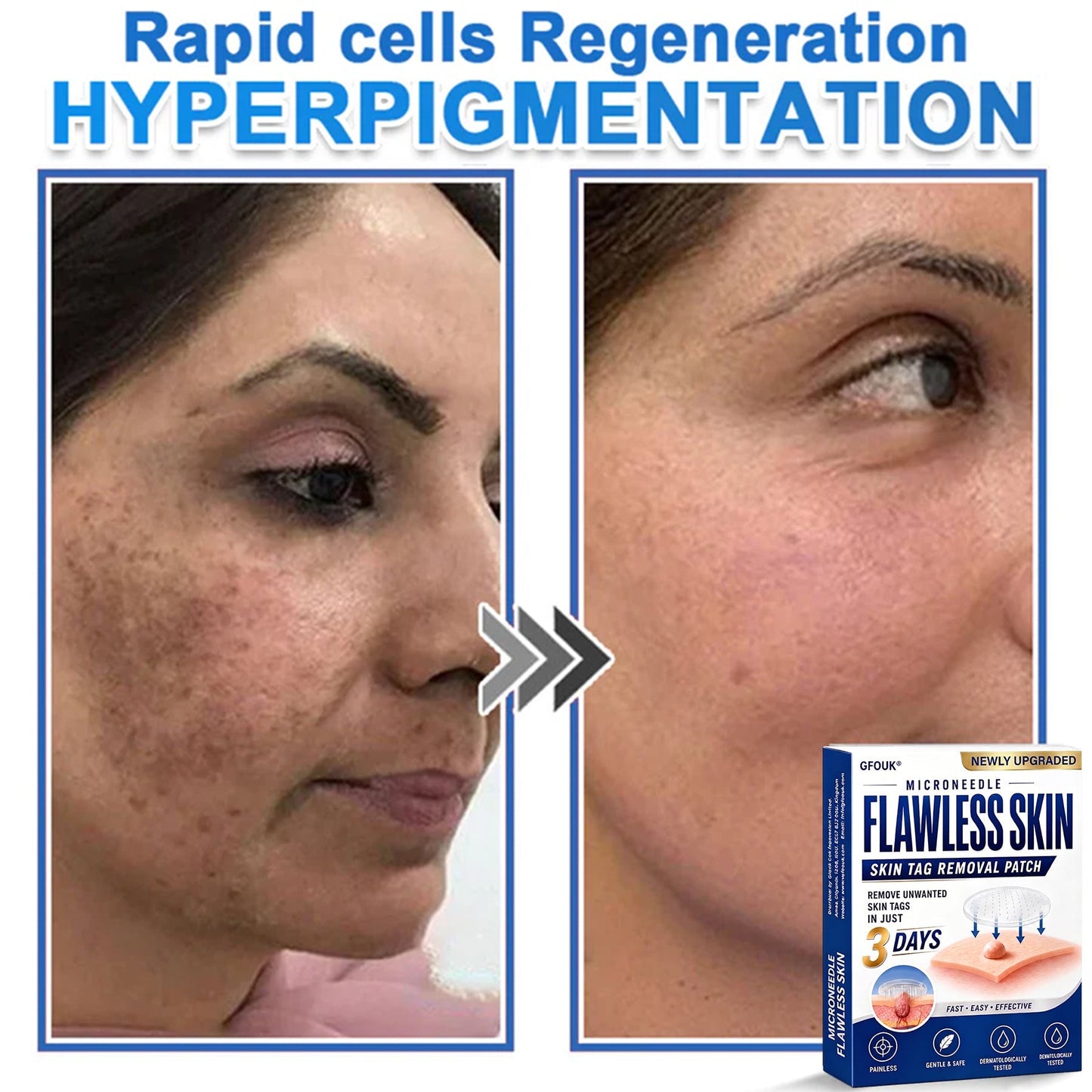 ⚡GFOUK® 2026 Newly Upgraded 2-in-1 Microneedle Hydrocolloid Patches | Removes Raised Moles, Acne, Flat Warts, and Skin Tags | Improves Wrinkles, Scars, and Blemishes | Invisible Acne Patches for Face & Body