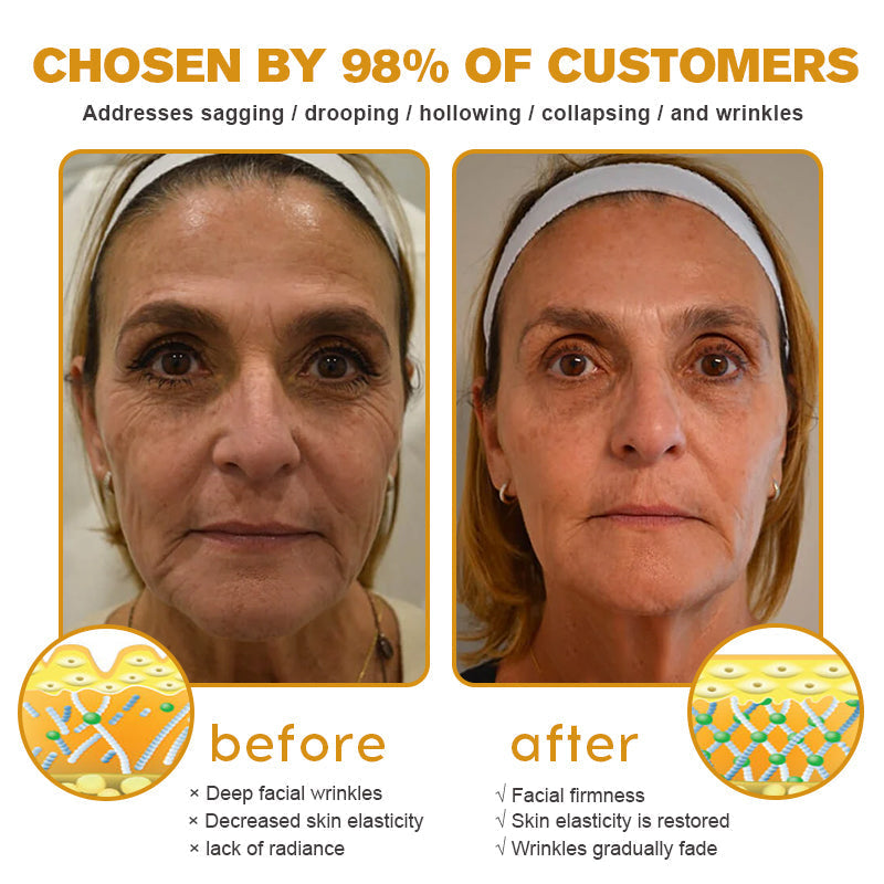 👩‍⚕️Made and Shipped from UK✅) Furzero™ Botox Bee Venom Wrinkle Removal Cream- LAST DAY 70% OFF